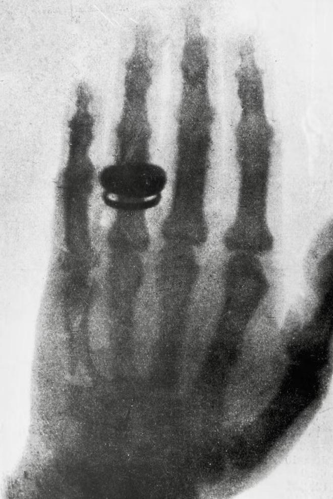 First medical X Ray ever made. Earliest photographic plates by Wilhelm