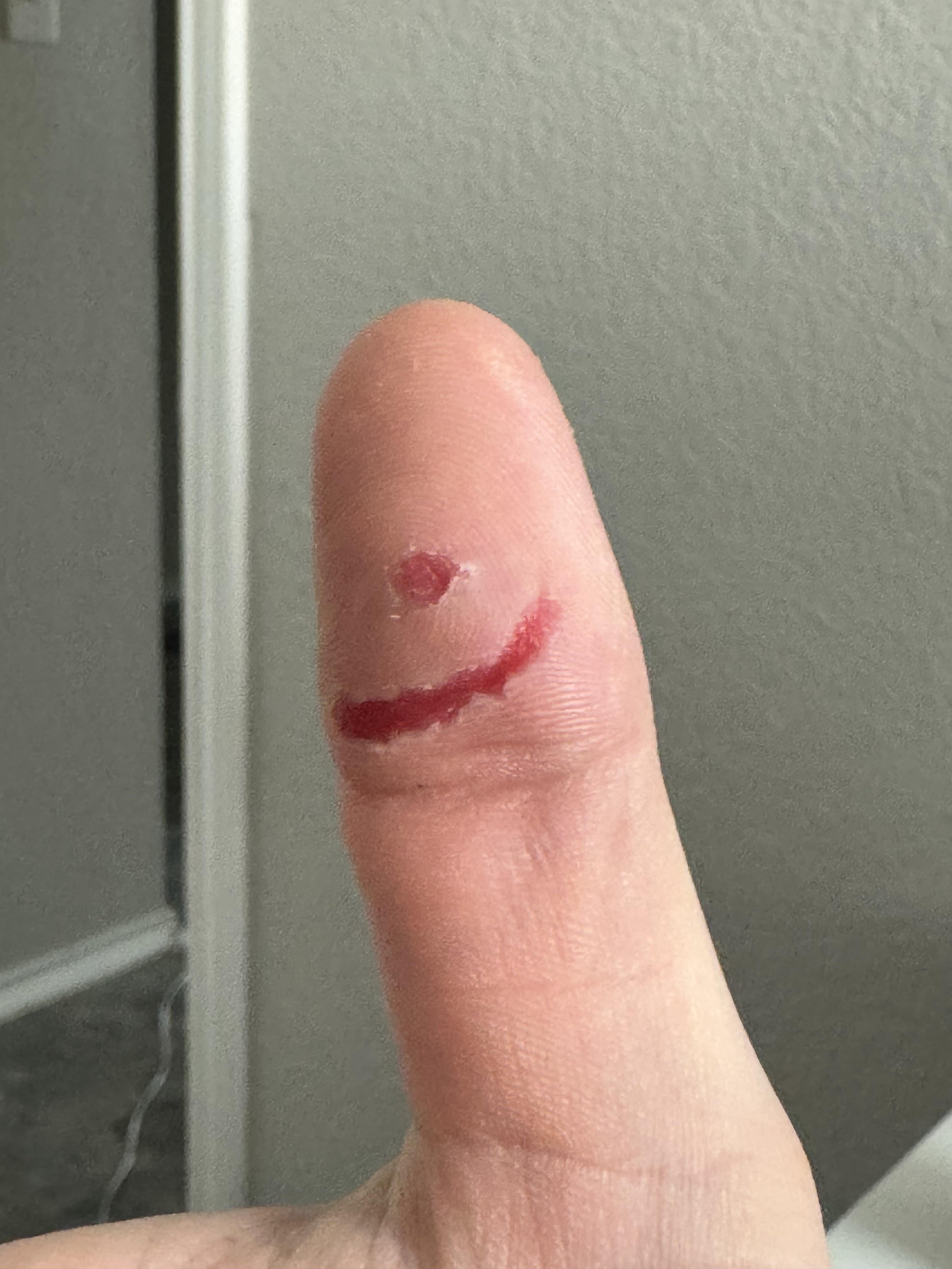 I burned my thumb this weekend on a hot piece of metal after